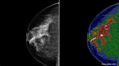 Is 3d Breast Cancer Detection Better Than The 2d