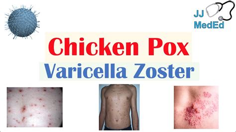 Varicella