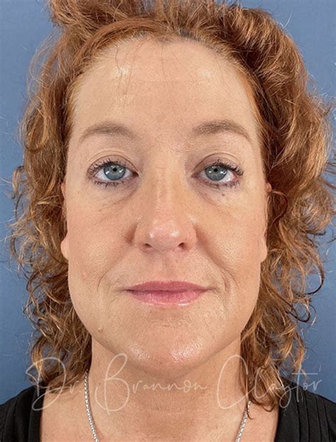 Myellevate Neck Lift Claytor Noone