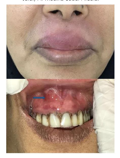 Figure 2 From Herbal Anti Edematous Agents For Certain Cases Of Facial Cellulitis Of Odontogenic