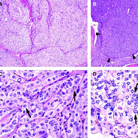 Representative Histological Findings Of Papillary Thyroid Carcinoma