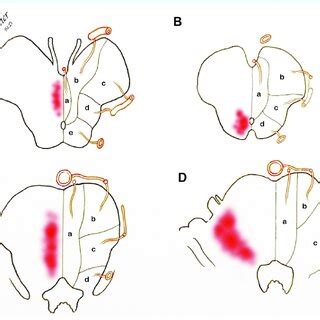 Compression features associated with Duret hemorrhage on brain imaging ...