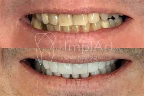 Lentes De Contato Dental Coroas Antes E Depois 49kb ImplArt