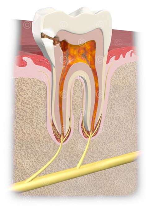 Illustrationen Wurzelspitzen Entz Ndung Medicalgraphics