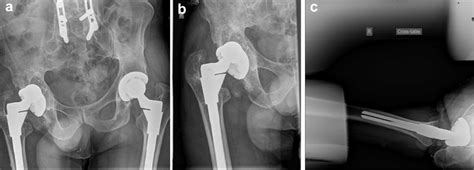 AP Pelvis A And Lateral Right Hip B Radiographs Taken During