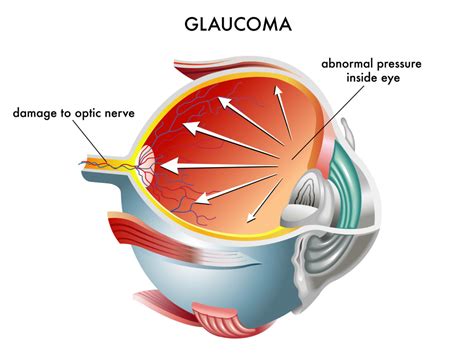 Ocular Disease Detection And Follow Up Whitney Eye Care