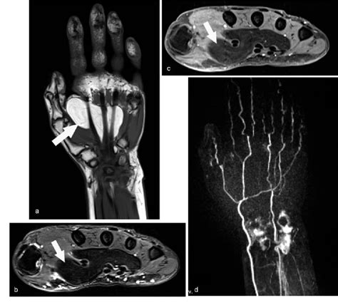 Figure 5 From Mri Of The Intrinsic Muscles Of The Hand Free Nude Porn