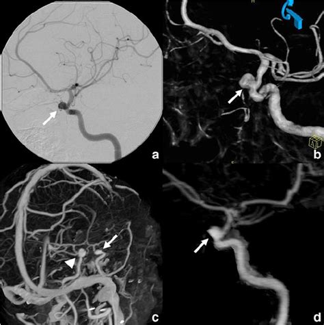 Case Correlation Between Dsa And Bonesubtracted Cta Aneurysm Of