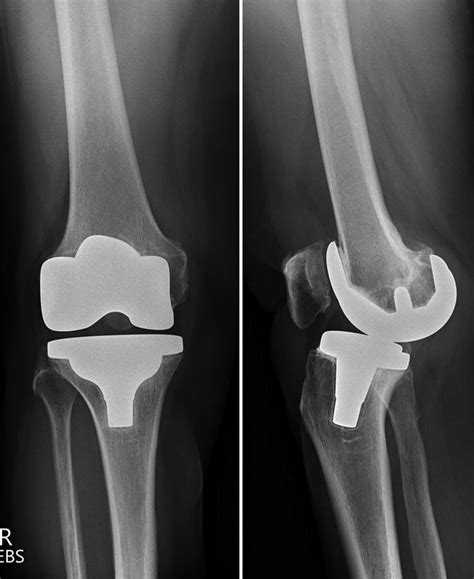 Instability Of Total Knee Replacement Musculoskeletal Key