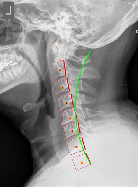 Chiropractic X Rays In Oakland Nj Mainspring Chiropractic