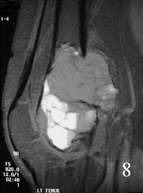 Giant Cell Tumor Of Bone Bone Tumors