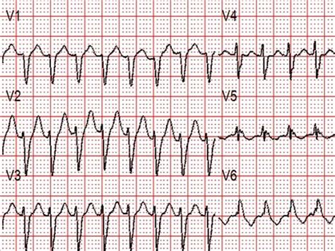 guidelines  management  svt published thesynapse