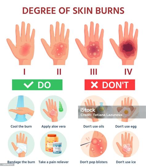 Burns Degree First Aid For Burn Wound Fire Damage To Skin