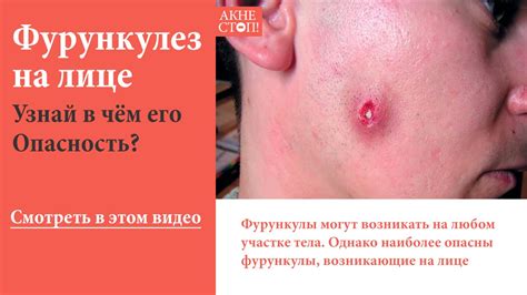 Фурункул на лице фото