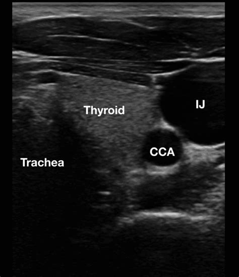 Ultrasound Guided Central Line Placement Made Easy Step By Step Guide