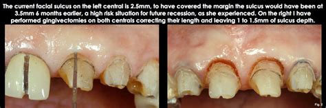 Sulcus Tooth