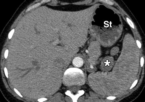 Blunt Tip Coaxial Introducer A Revisited Tool For Difficult Ct Guided