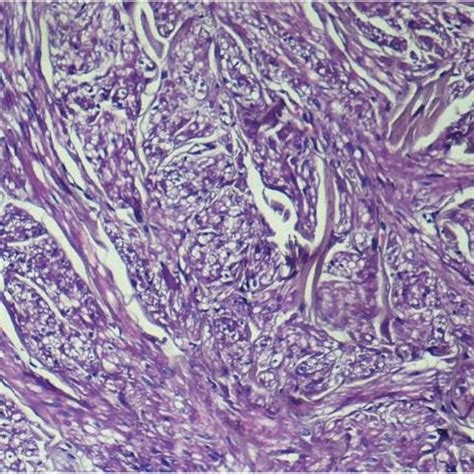 Low Magnification View Of Cutaneous Leiomyoma Showing Smooth Muscles