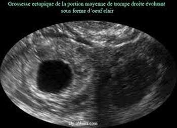 Grossesse Extra Uterine Medecine