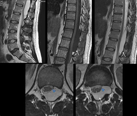 Spinal Arachnoid Cyst