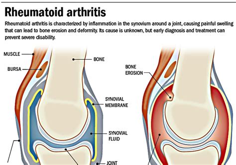 What Is Synovitis, And How Does It Affect Arthritis? –, 58% OFF