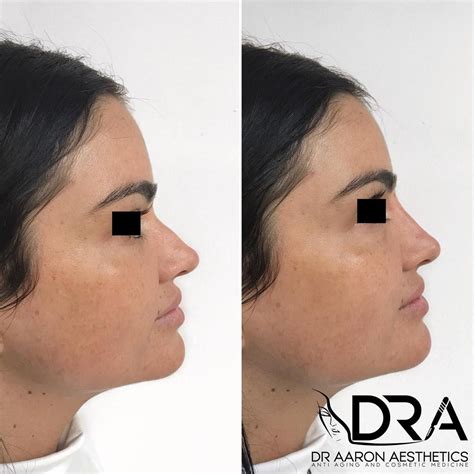 Non Surgical Rhinoplasty Purpose To Hide Bumps Straighten Your Nose