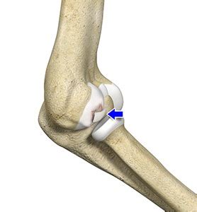 Osteochondritis Dissecans OCD Of The Capitellum Orland Park IL