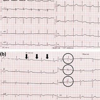 Ecg Of The Patient Showed Initially Normal Sinus Rhythm Day Panel