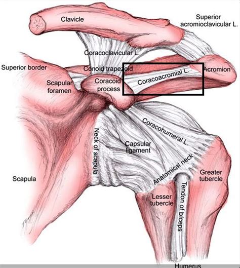 Coracoacromial Ligament Tear