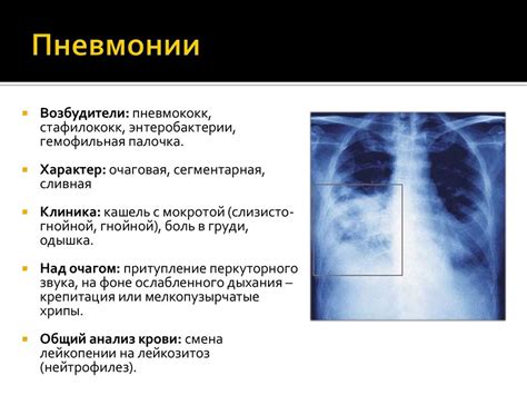 Грипп (Grippus, Influenza) - презентация онлайн