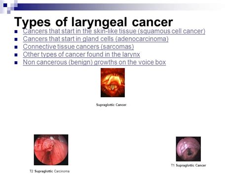 What Is Cancer Of The Larynx Laryngeal And Hypopharyngeal Cancer Brigham And Women S Faulkner