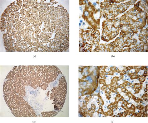 Figure 1 From Cytoplasmic Staining Of TTF 1 Antibody In The Diagnosis