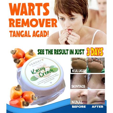 Flash Sale Authentic Kasoy Cream Warts Remover Warts Remover