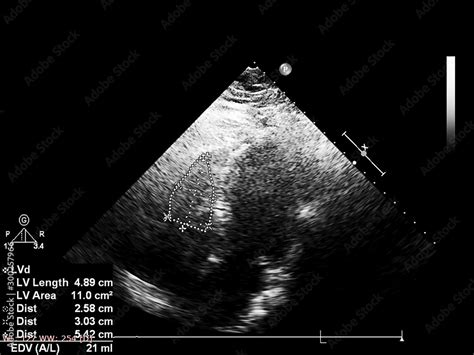 Screen of echocardiography (ultrasound) machine. Stock Photo | Adobe Stock