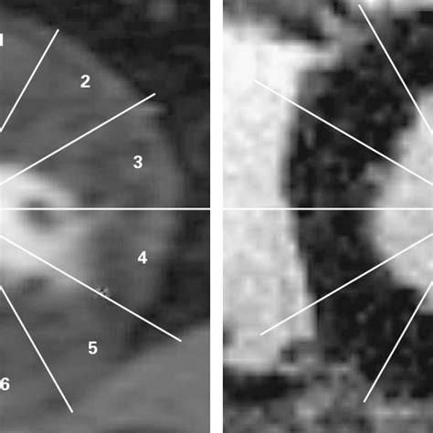 Typical Cine Image And Contrast Enhanced Image Obtained By Mri Before Download Scientific