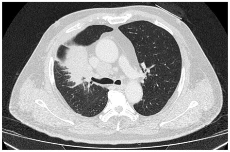 Small Cell Lung Cancer With Endobronchial Growth A Case Report