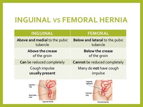 [diagram] Diagram Of Femoral Hernia Mydiagram Online