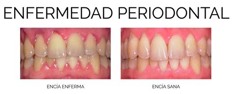 Qu Es La Piorrea Cl Nica Dental Ceballos