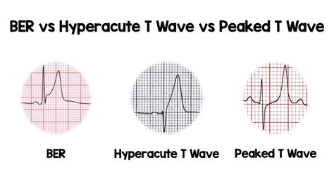 T Waves - REBEL EM - Emergency Medicine Blog