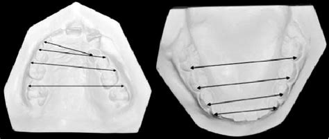 Distances Of Arch Widths In The Maxillary And Mandibular Arches