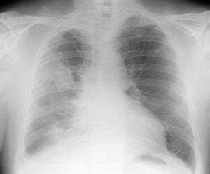 What is Epithelioid Mesothelioma? Signs, Treatment, Prognosis