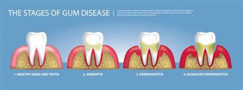 Gum Disease Vector Art, Icons, and Graphics for Free Download