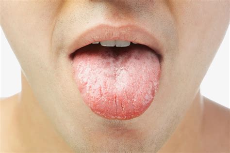 Why Do I Have Cracks In My Tongue? Fissured Tongue Explained