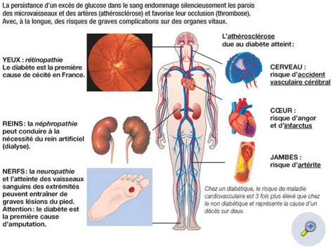 La Neuropathie Diab Tique Par Le Dr Herbreteau Service De Neurologie