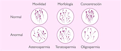 Qué es el seminograma y cuándo se considera normal