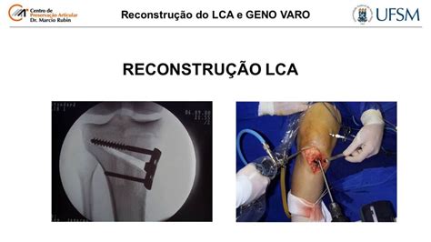 Aula Reconstrucao Lca E Osteotomia Centro De Preserva O Articular