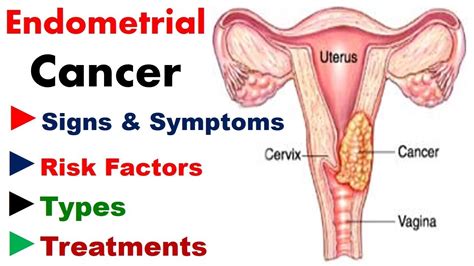 Endometrial Cancer Signs Symptoms Risk Factors Types Treatments