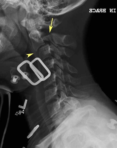 Hangman S Fracture X Ray Radrounds Radiology Network