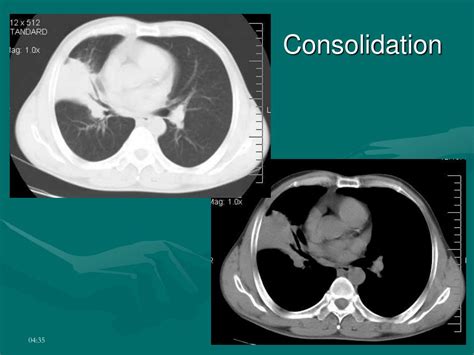 Ppt Imaging Pattern Of Respiratory Disease Powerpoint Presentation