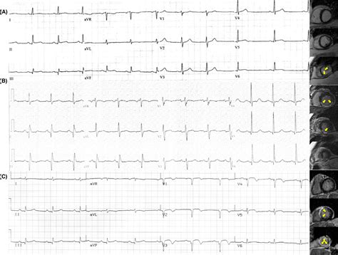 Estimating Myocardial Infarction Size With A Simple